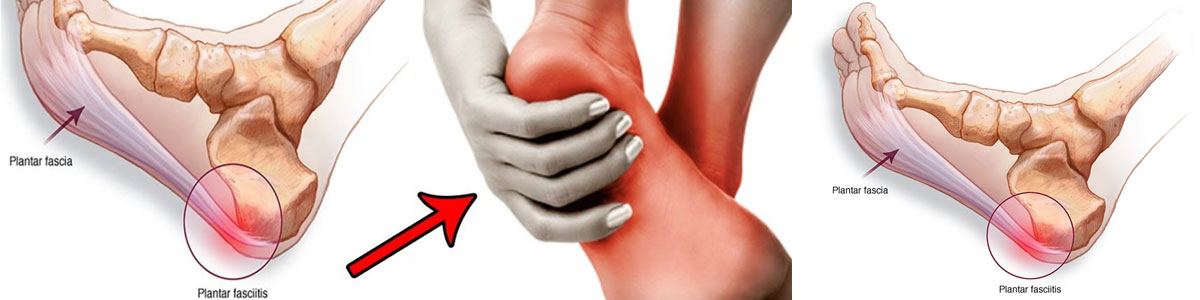 PLANTAR FASCIITIS