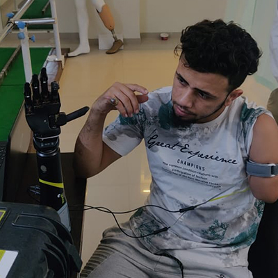 upper-extremity-prosthetics