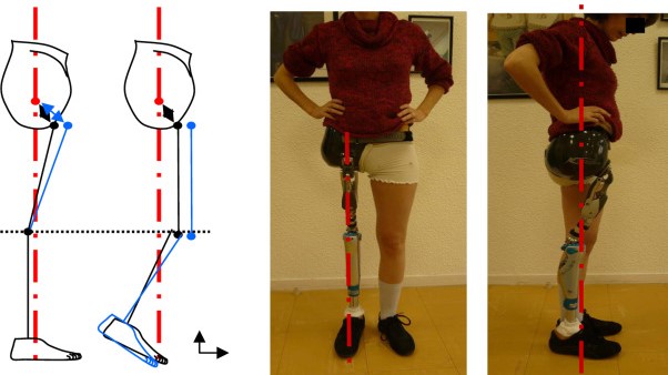 Knee Disarticulation Prosthetic